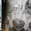 Usa, ruba un anello e lo ingoia: la polizia la incastra con una radiografia FOTO01