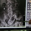 Cina, va all'ospedale per stitichezza: nell'intestino ha una bottiglia FOTO01