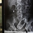 Cina, va all'ospedale per stitichezza: nell'intestino ha una bottiglia FOTO02