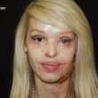 Katie Piper, sfregiata con l'acido pubblica le foto: "I segni non mi spaventano"