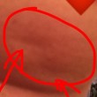 Tumore al seno, donna pubblica foto su Facebook del suo: "Attenti alle fossette"