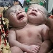 Bangladesh, nata bimba con due teste e un solo corpo 2