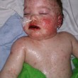 Ibuprofene a bimbo allergico: così gli ha ridotto pelle 02