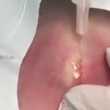 YOUTUBE Ciste al seno, medico la incide: ecco cosa esce... 2