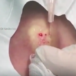 YOUTUBE Ciste al seno, medico la incide: ecco cosa esce... 5