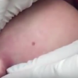 YOUTUBE Ciste al seno, medico la incide: ecco cosa esce... 9