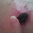 Video YouTube - Melanoma "guarisce" con il balsamo nero 2