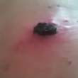 Video YouTube - Melanoma "guarisce" con il balsamo nero 3