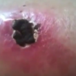 Video YouTube - Melanoma "guarisce" con il balsamo nero 4