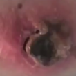 Video YouTube - Melanoma "guarisce" con il balsamo nero 7