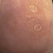 Verruca a mosaico rimossa da piede lascia buco3