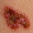 Cancro della pelle per troppi lettini abbronzanti. I sintomi07