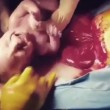 Bambino nel sacco amniotico subito dopo cesareo3