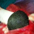 Palla di capelli grossa quanto un melone rimossa dallo stomaco