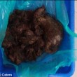 Palla di capelli grossa quanto un melone rimossa dallo stomaco 3