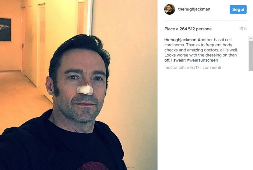 Hugh Jackman operato di nuovo: torna il cancro alla pelle