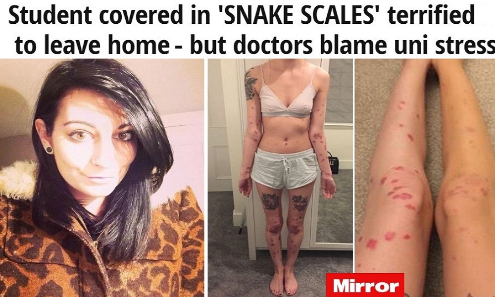 Beth, la ragazza con la "pelle di serpente" FOTO