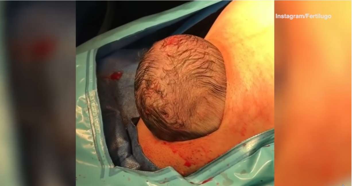 Venezuela sceglie il cesareo dolce: un taglio sulla pancia e il bimbo esce da solo VIDEO