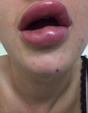 Iniezioni alle labbra per averle più carnose, ecco cosa le succede