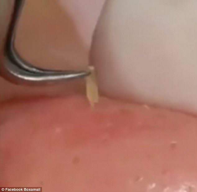 L'innovativa pinzetta da 5 euro per rimuovere i punti neri