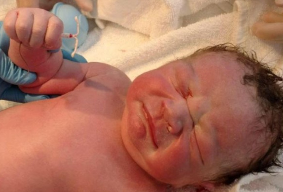 Contraccettivo non funziona, il neonato ha la spirale in mano FOTO
