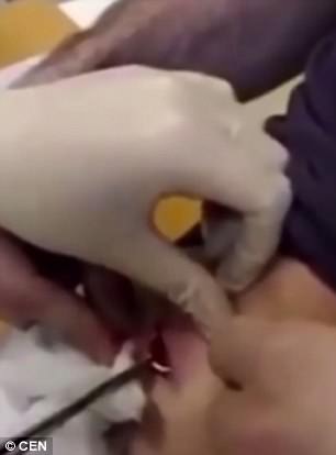 Si cuce all'altezza dello stomaco l'anello