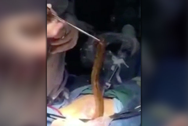 YOUTUBE Si infila anguilla nel sedere. Ai medici spiega: "L'ho fatto per curare la stitichezza"