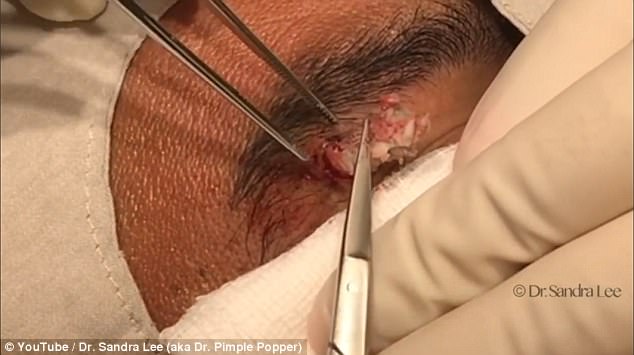 Cisti rimossa dal sopracciglio pus sembra formaggio