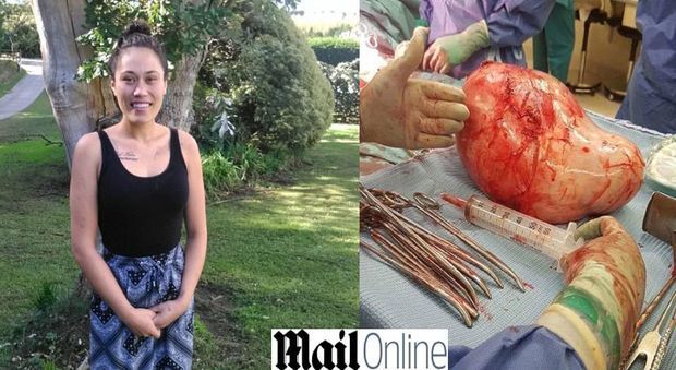 Donna crede di essere incinta, medici fanno una scoperta choc FOTO