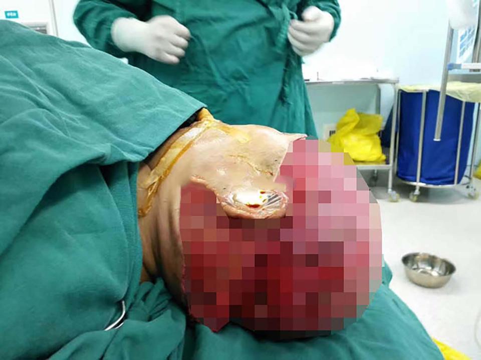 I capelli dell'operaia si impigliano, la macchina le fa lo scalpo