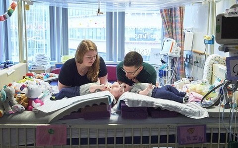 Gemelline siamesi unite dalla testa