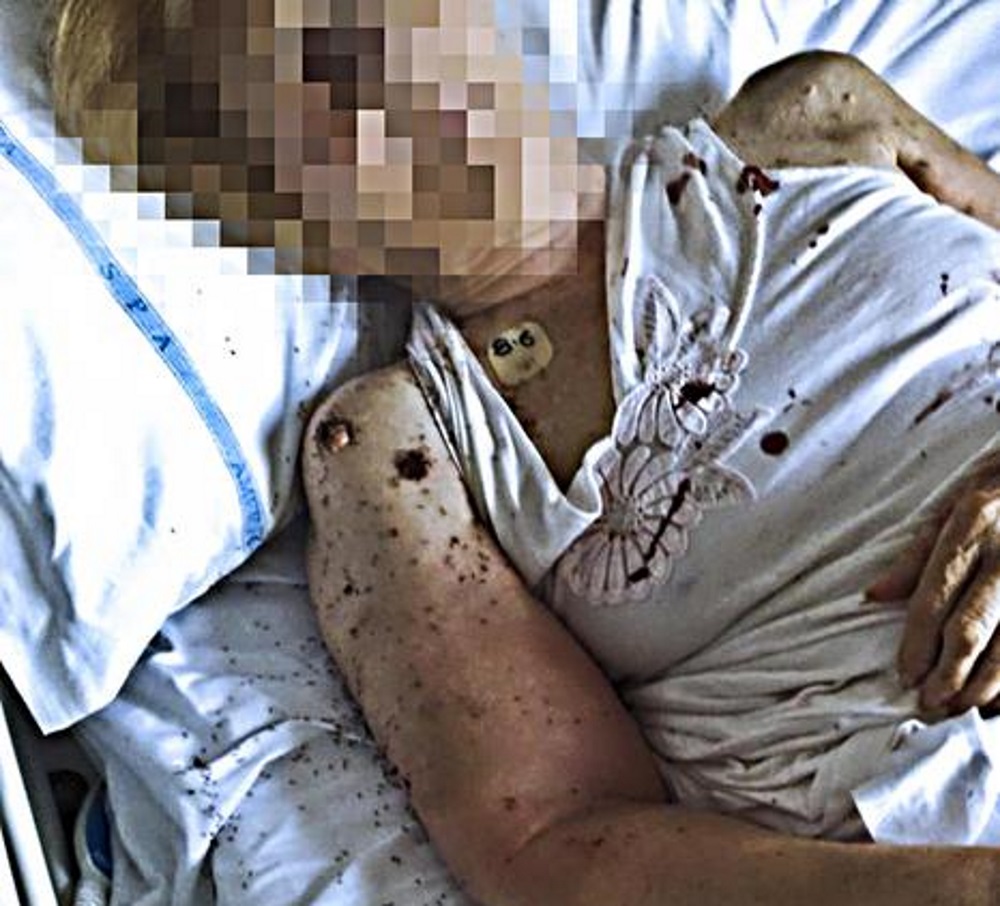 Napoli, centinaia di formiche sulla paziente nel letto di ospedale al San Paolo