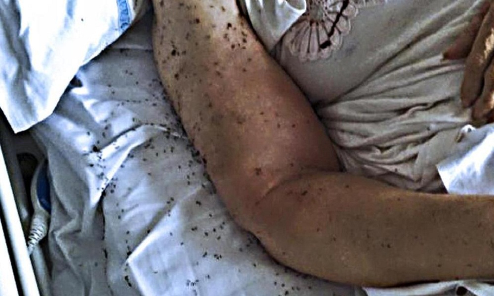 Napoli, ospedale San Paolo: "Le formiche lì ci sono ogni estate"