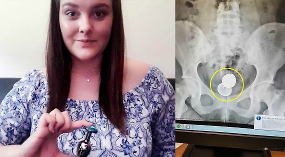 Durante rapporto il "giocattolino" le rimane incastrato: operata