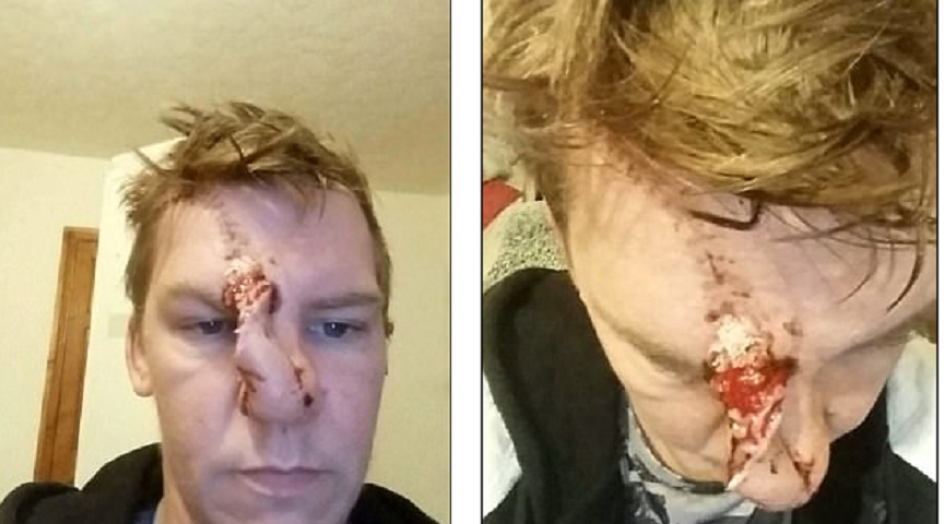 In fila al pub, sconosciuto gli morde il naso FOTO Ecco come lo riduce