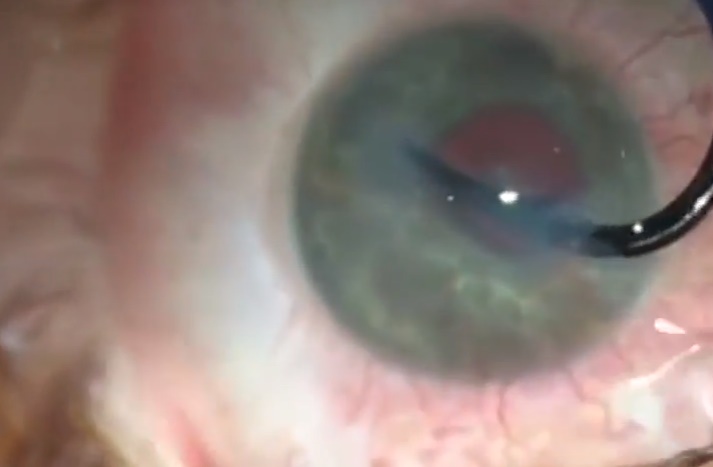 Amo da pesca rimosso dall'occhio: VIDEO dell'operazione è spettacolare