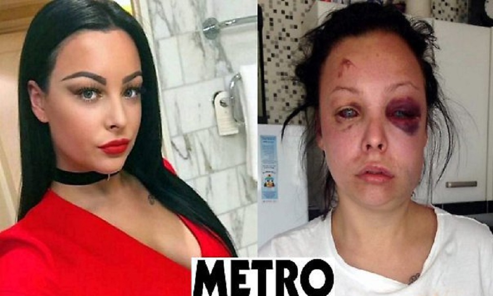 Picchiata dal compagno: "Ecco come mi ha ridotto" FOTO