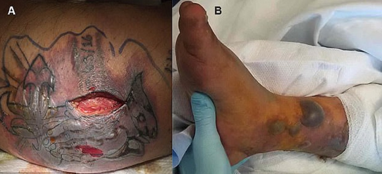 Muore per un bagno in mare dopo il tatuaggio: ferita infettata dal batterio mangia-carne