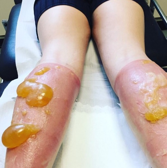 Corre per 21 ore sotto al sole: sulle gambe si formano delle mega vesciche