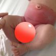 Bimbo ustionato per colpa del pannolino scadente
