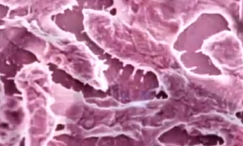 In Alabama è emergenza fascite necrotizzante: il batterio mangia carne