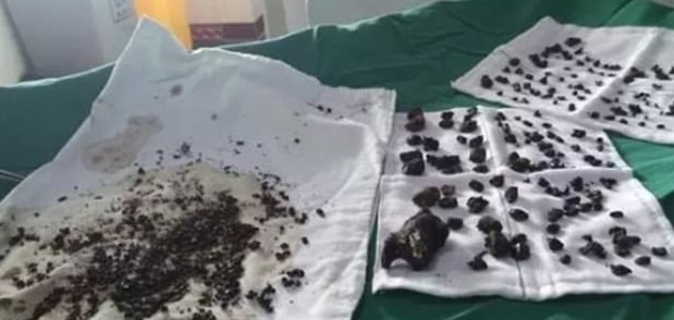 Cina, donna operata di calcoli. I medici ne rimuovono 200: "Alcuni grandi come uova"