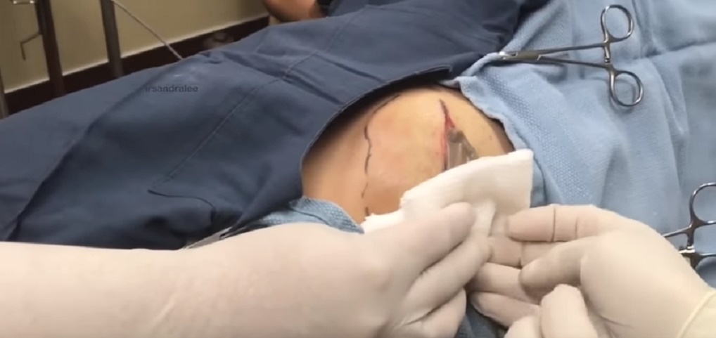 Pimple Popper spreme cisti vecchia di 50 anni: ecco cosa esce fuori