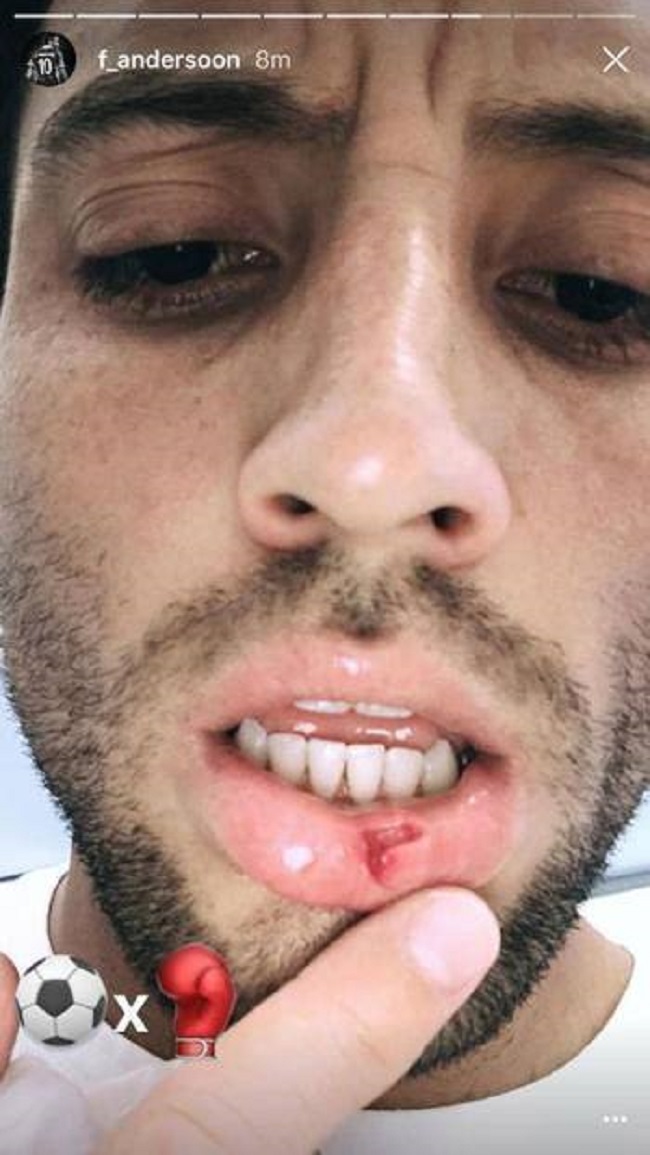 Felipe Anderson, rissa con Hoedt: il brasiliano mostra il labbro rotto su Instagram