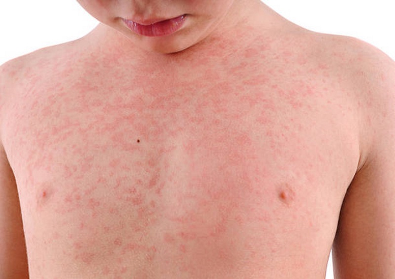 Morbillo non si ferma: più 400 casi a giugno rispetto a un anno fa