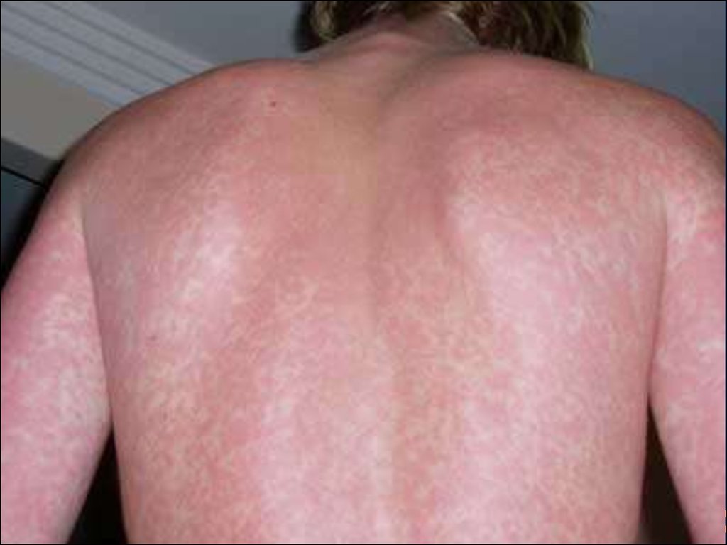 Vietri sul mare, allarme morbillo in hotel: 3 casi, a rischio contagio 700 ospiti
