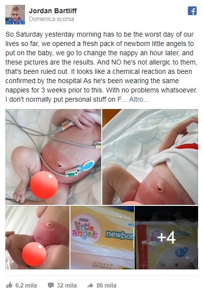 Bimbo ustionato per colpa del pannolino scadente