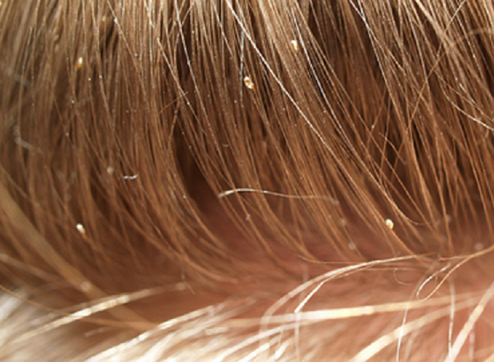 Firenze: benzina per eliminare i pidocchi, mamma e figlia gravemente ustionate