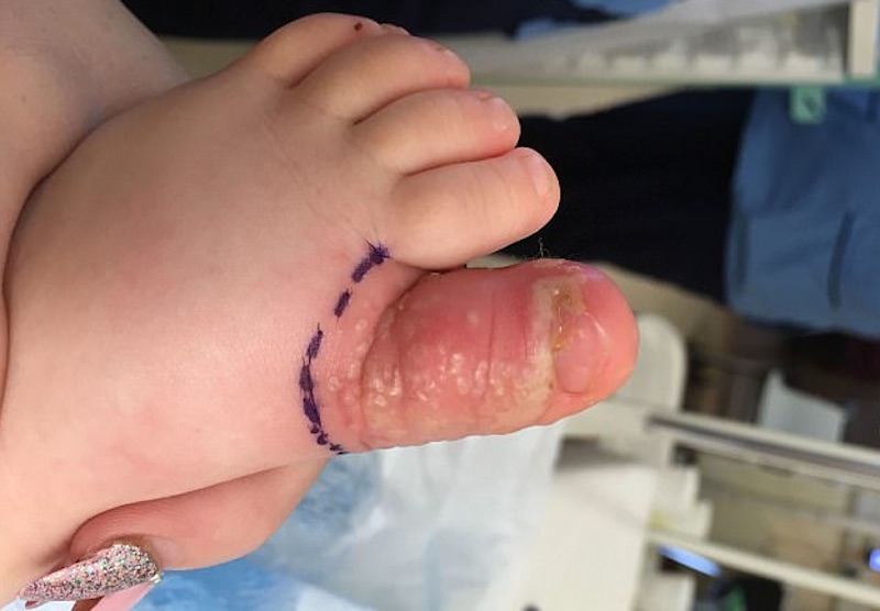 Bimba di 18 mesi calpesta urina di cane: le hanno amputato un pezzo di alluce