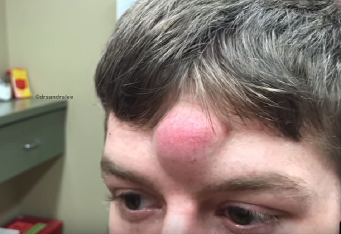 Dottor Pimple Popper, cioè la dottoressa Sandra Lee, estrae la cisti unicorno. Il video dell'intervento